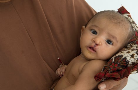 Smile Train patient after cleft surgery