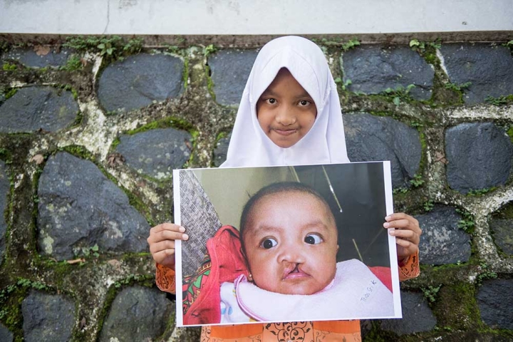 Smile Train patient smiling and holding a photo of herself before cleft surgery
