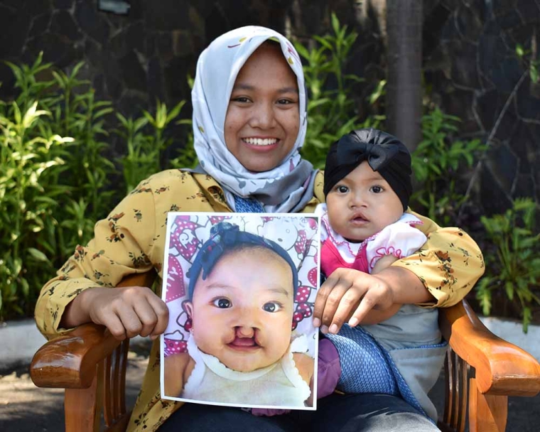 Cleft-affected patient smiling with their mother and holding a picture of themself before cleft surgery